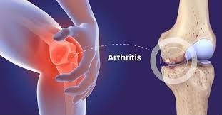 Athritis