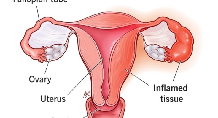 Pelvic Inflammatory Disease