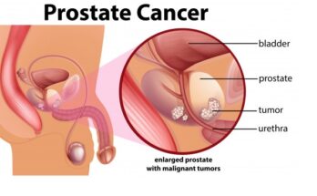 Prostate Cancer