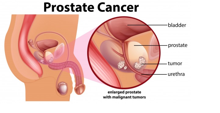 Prostate Cancer