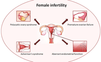 Female Infertility