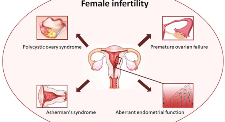 Female Infertility