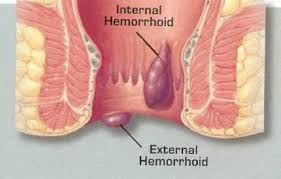 hemorrhoid pile