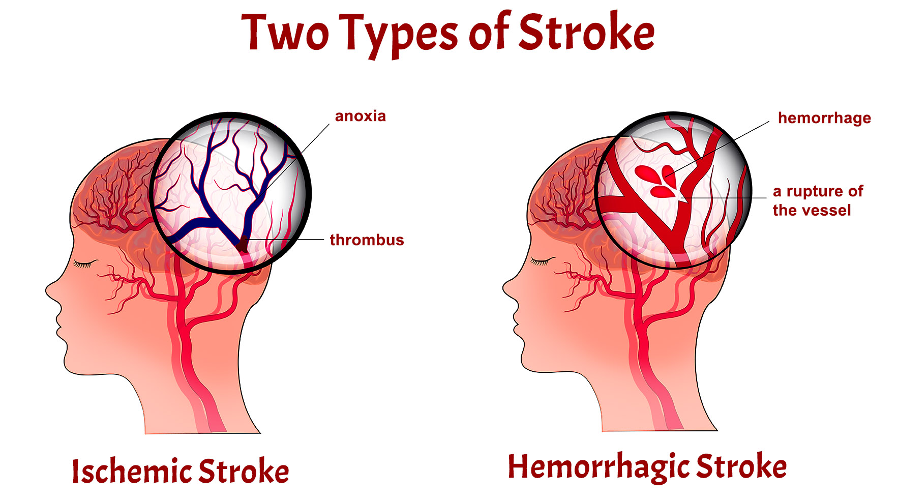 Types of Stroke